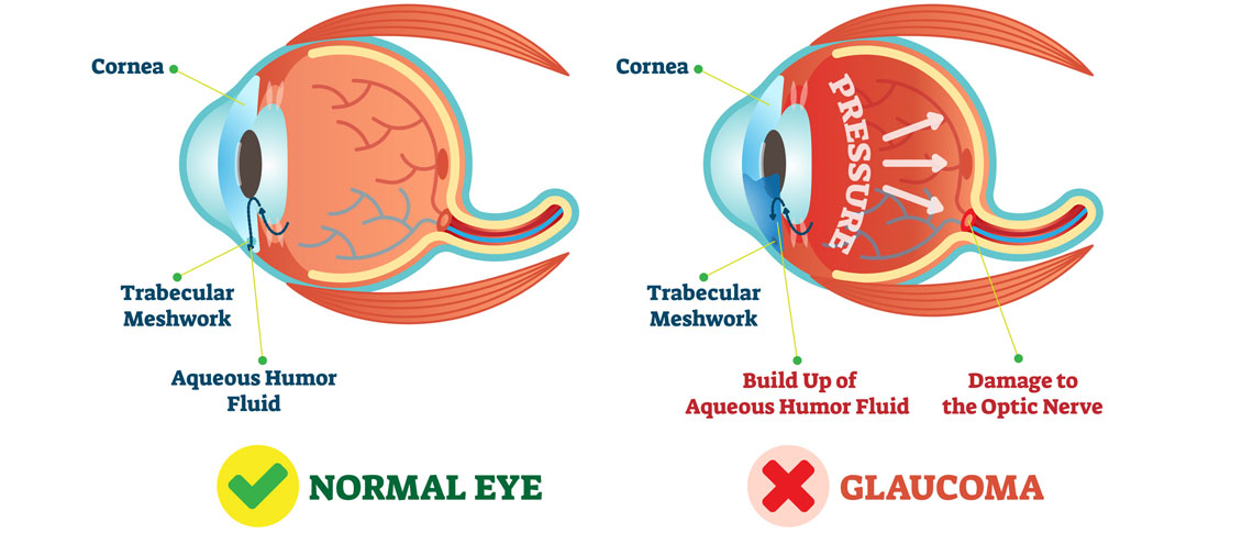 low angle glaucoma