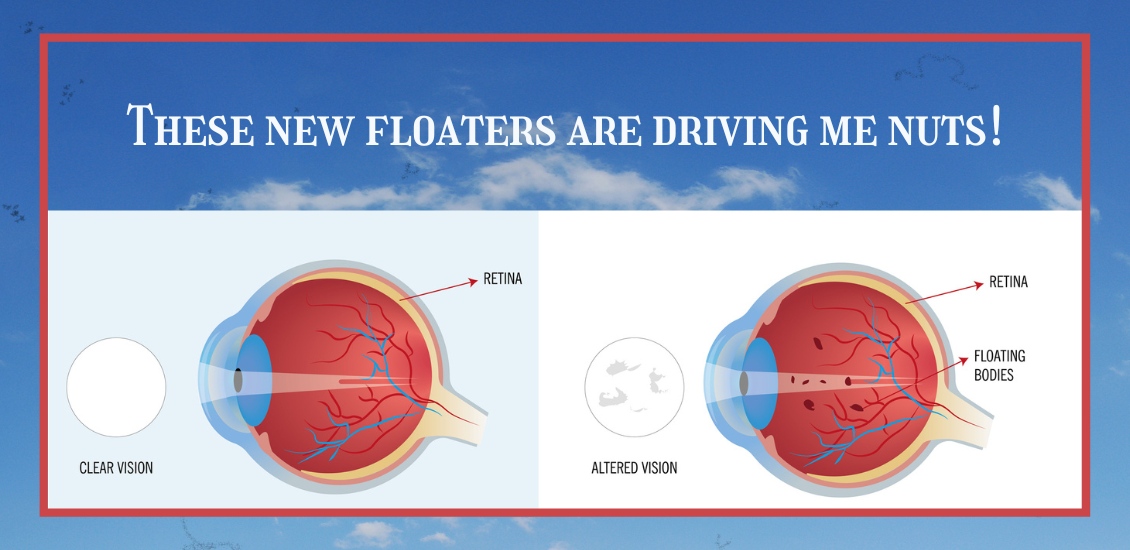 What To Do About Those Pesky Floaters Eye Doctor Eye Care In 